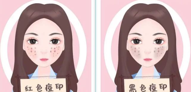 臉上紅色痘印幾個(gè)月都不消怎么辦？紅色痘印應(yīng)該怎么消除？